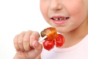 Caries (Tooth Decay) 