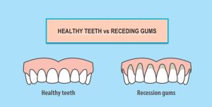 receding gums vs healthy teeth